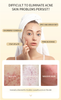 Propolis Acne Serum-Soothing, Oil-Control & Pore-Refining for Sensitive Skin